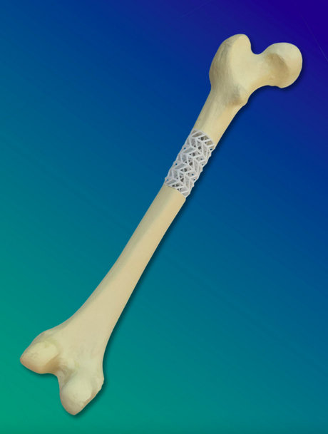BIOACTIVE COMPOSITE SUPPORTS HEALING OF BROKEN BONES